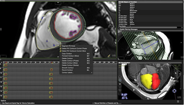 Circle Cardiovascular Imaging CVI42